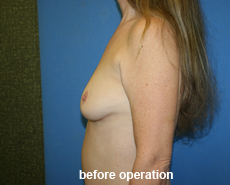 plastic-surgery-breast-augmentation